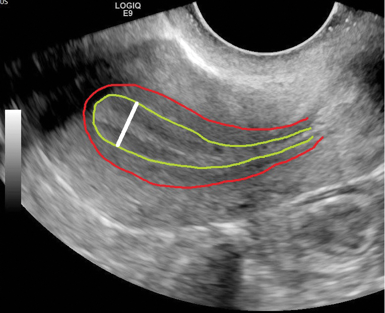 The Importance of Endometrial Health in IVF Success - Shukan Hospital ...