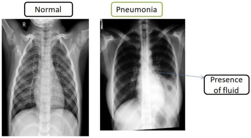 Chest X-Ray Classification
