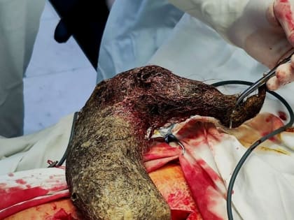 Хирурги в Минводах извлекли из желудка пациентки пучок волос