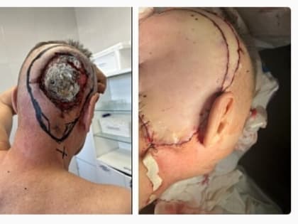 Хирурги Ставропольского онкологического диспансера и Ставропольской краевой клинической больницы провели сложную операцию пациенту с раком кожи волосистой части головы