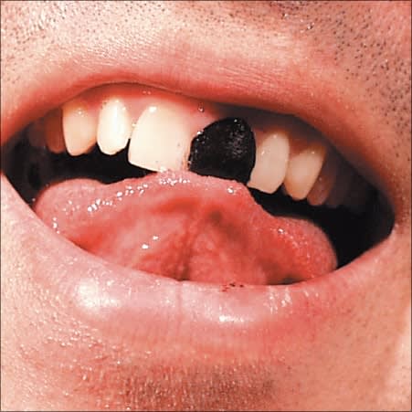 Tooth Wax Tip 3