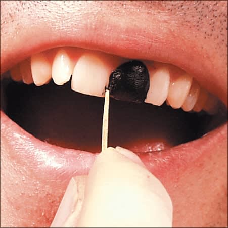 Tooth Wax Tip