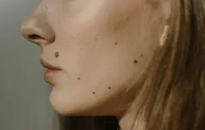 Chin & Jawline Chin & Jawline