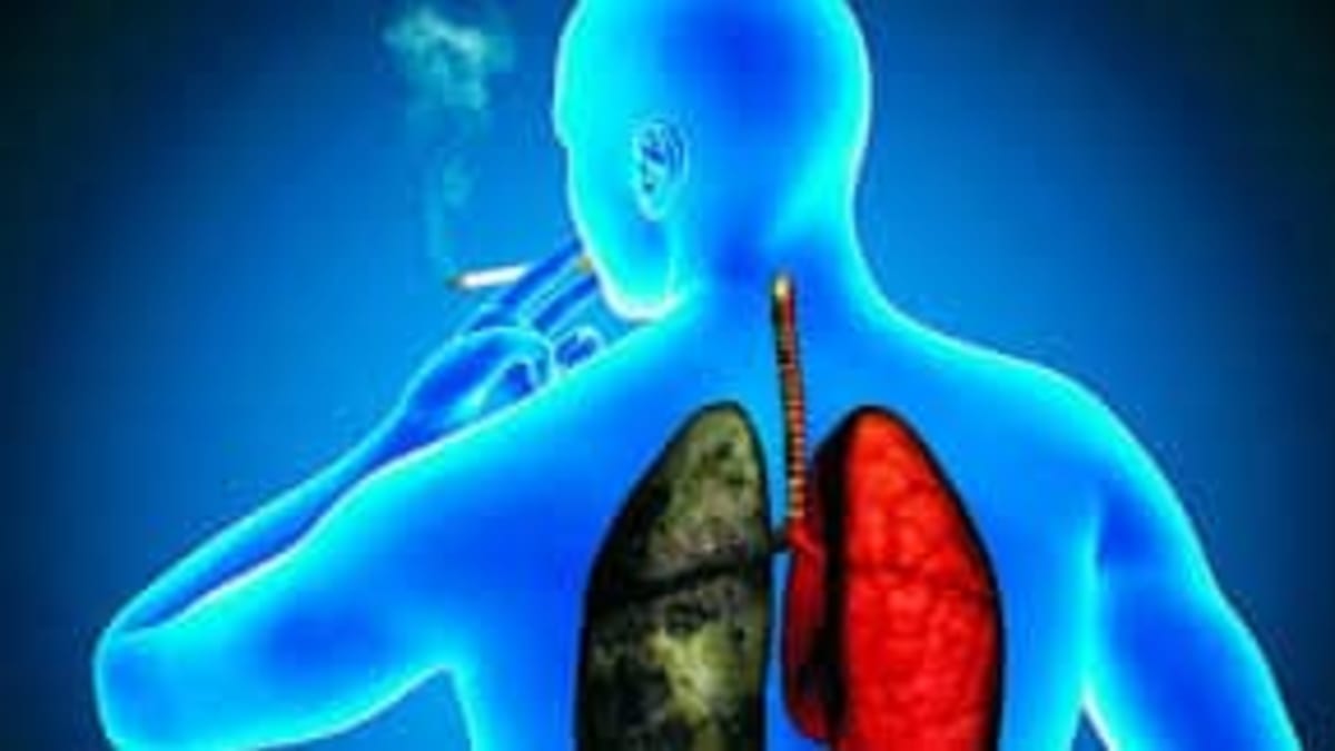 El cáncer de pulmón, primera causa de muerte oncológica en el país, podría aumentar casi un 80% para 2050