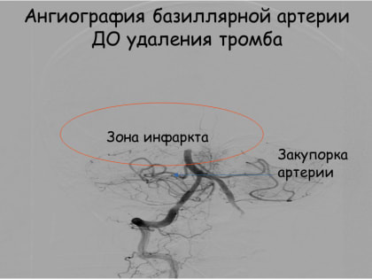 Королёвские врачи спасли 66-летнего мужчину с инсультом