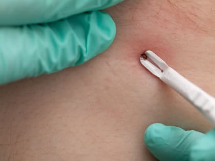 В России выявлен клещевой энцефалит в нетипичных для инфекции регионах