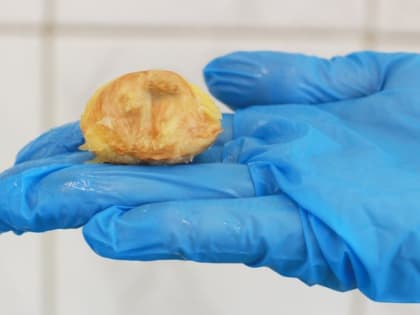 В Сергиево-Посадской больнице врачи спасли мужчину, проглотившего косточку от персика