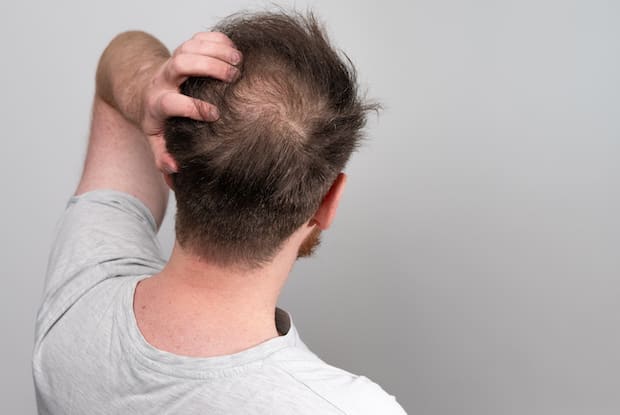 a man scratching at his balding spot