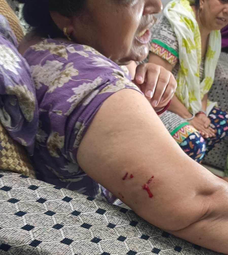 महेंद्रगढ़ | बंदरों के झुंड ने महिला पर किया हमला : गंभीर रूप से घायल | अस्पताल में भर्ती