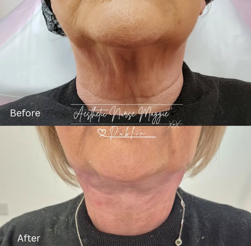 Before and After Treatment Result 4