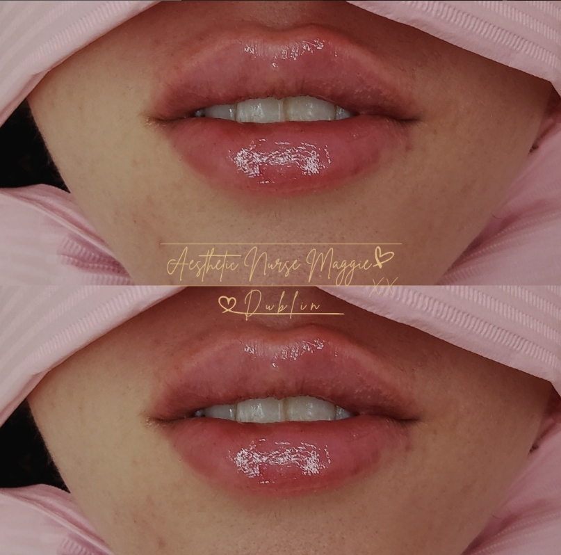 Before and After Treatment Result 1