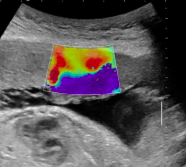 Diagnostic Ultrasound for Maternal/Fetal Applications