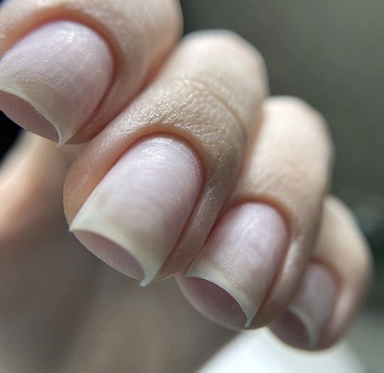 Dépose gel