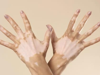 25 июня — Всемирный день витилиго