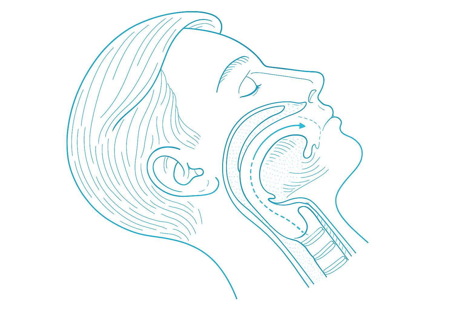 Upper Airway Resistance Syndrome (UARS)