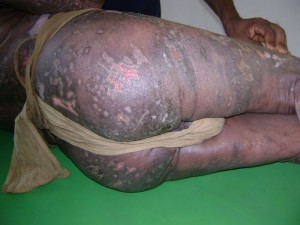 Psoriasis Psoriasis
