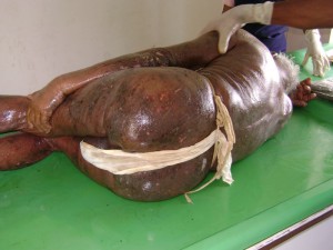 Psoriasis Psoriasis - Psoriasis Causes