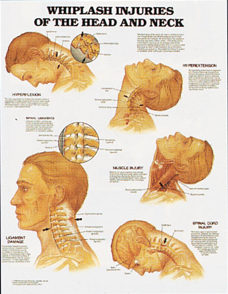 Whiplash Injuries of the Head & Neck Chart