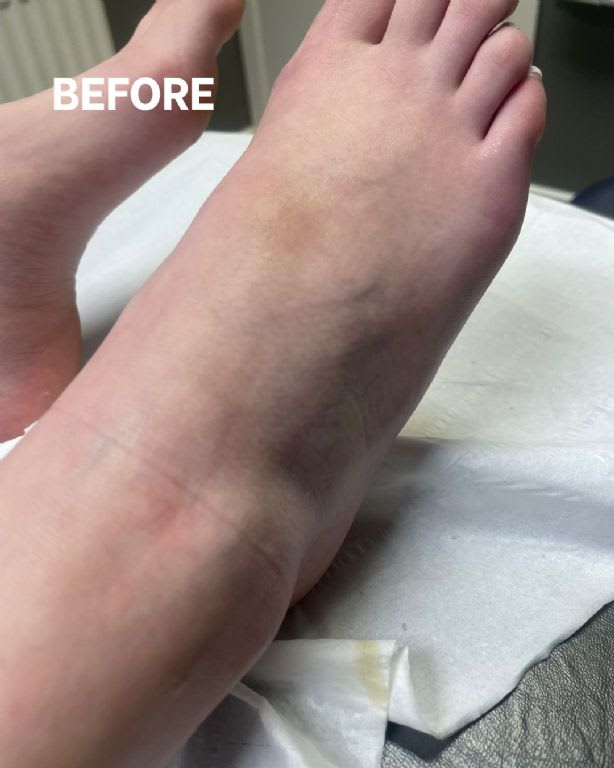 before after tecar foot (2)