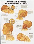 Whiplash Injuries of the Head & Neck Chart