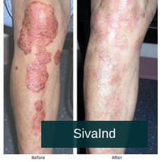 AROGYAM PURE HERBS KIT FOR PSORIASIS