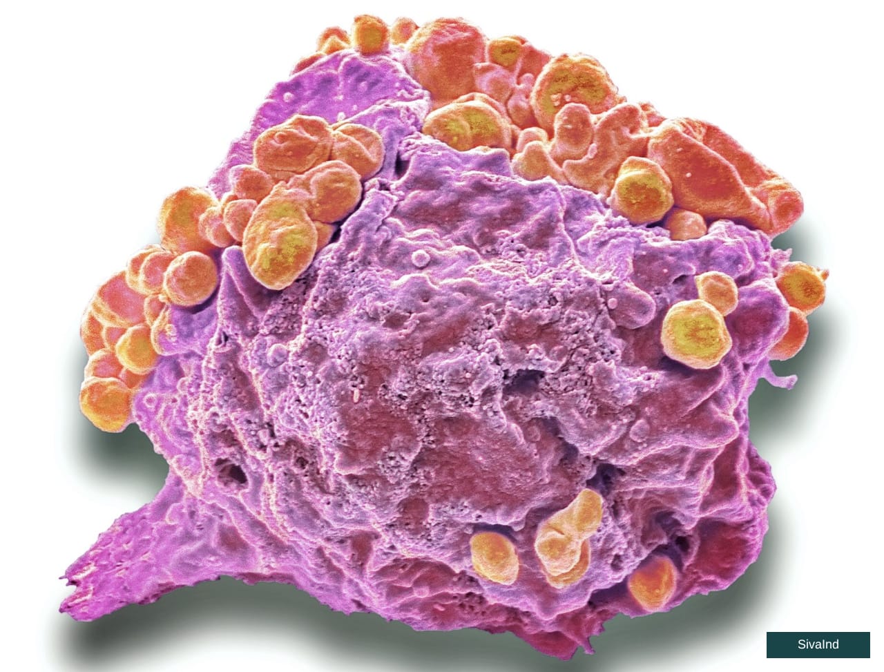 Best Lymphoma and Immunotherapy Cancer Treatment in Noida | Dr. Manish Singhal