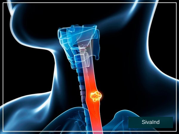 Expert Esophageal Cancer Doctor in Noida | Cancer Consult