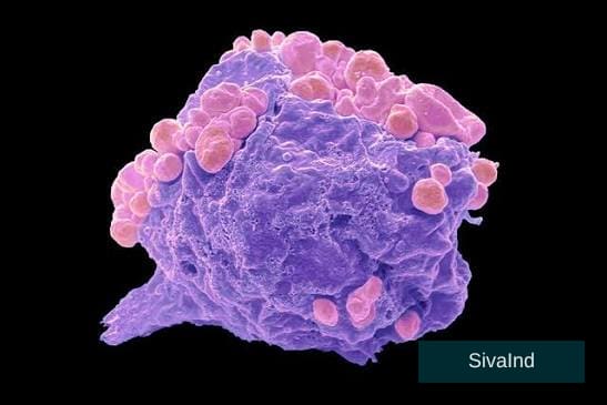 Advanced Lymphoma Cancer Treatment in Noida | Cancer Consult