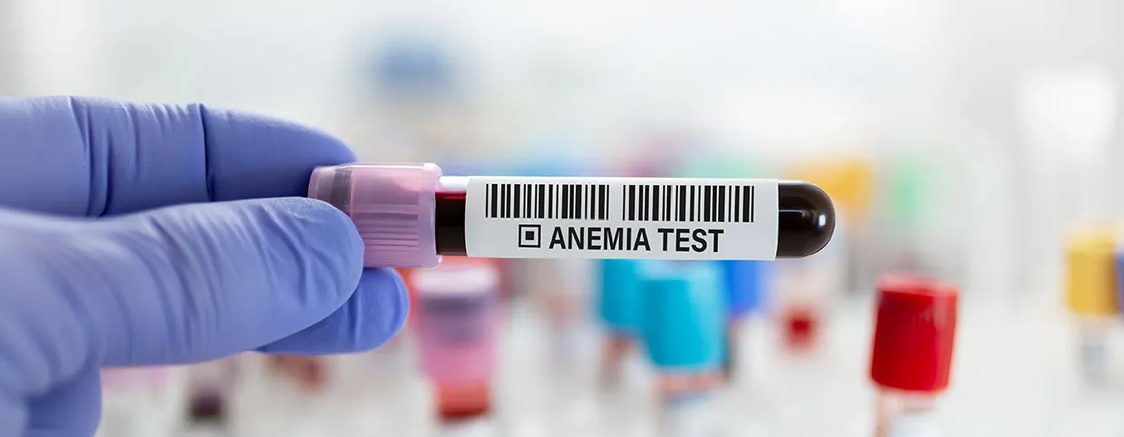 Iron-Deficiency Anemia: The Importance Of Health Checkups And CBC Testing
