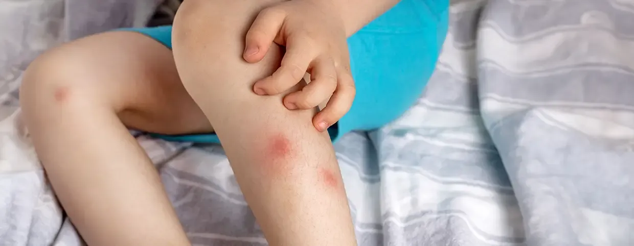 نصائح واستراتيجيات للوقاية من حمى الضنك
