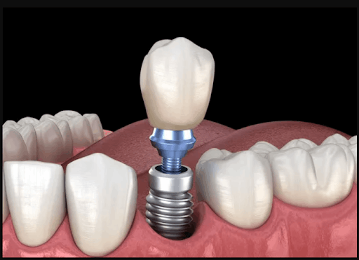Don't Let the Cold Worsen Your Missing Teeth: Why Winter 2026 is the Time for Implants