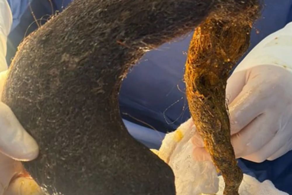 Síndrome de Rapunzel, l'estrany trastorn que va portar a una dona al quiròfan per a extreure-li una bola de pèl que ocupava el 90% del seu estómac
