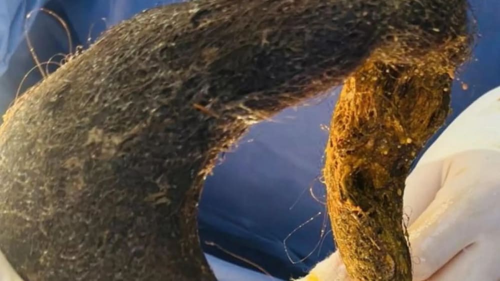 Una gegantesca bola de pèl ocupa el 90% de l'estómac d'una dona: l'estranya síndrome de Rapunzel