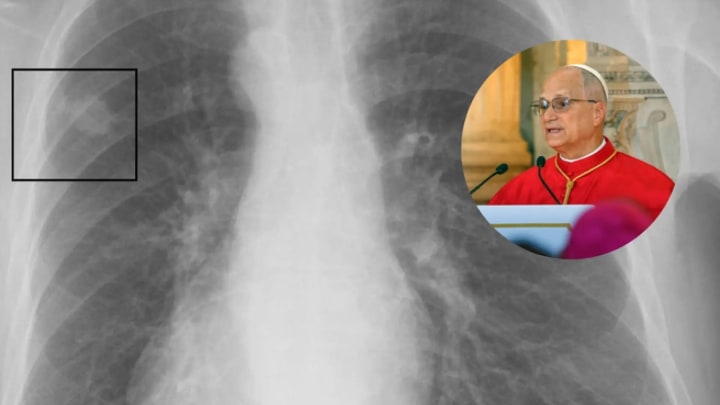 Què és un nòdul pulmonar, la lesió per la qual el Papa León XIV ha de passar per quiròfan