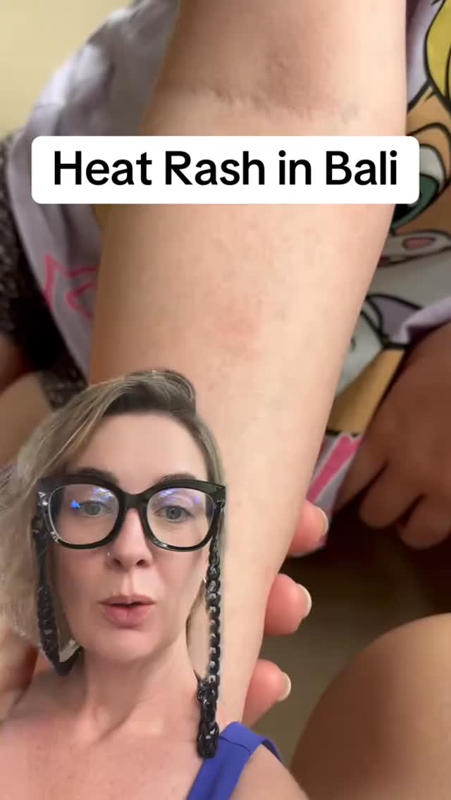 Heat Rash in Bali - One of the most common things we see families dealing with in Bali! 👀☀️

Also k