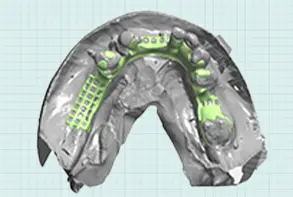 Removable Prosthodontics Design | Reliable Results