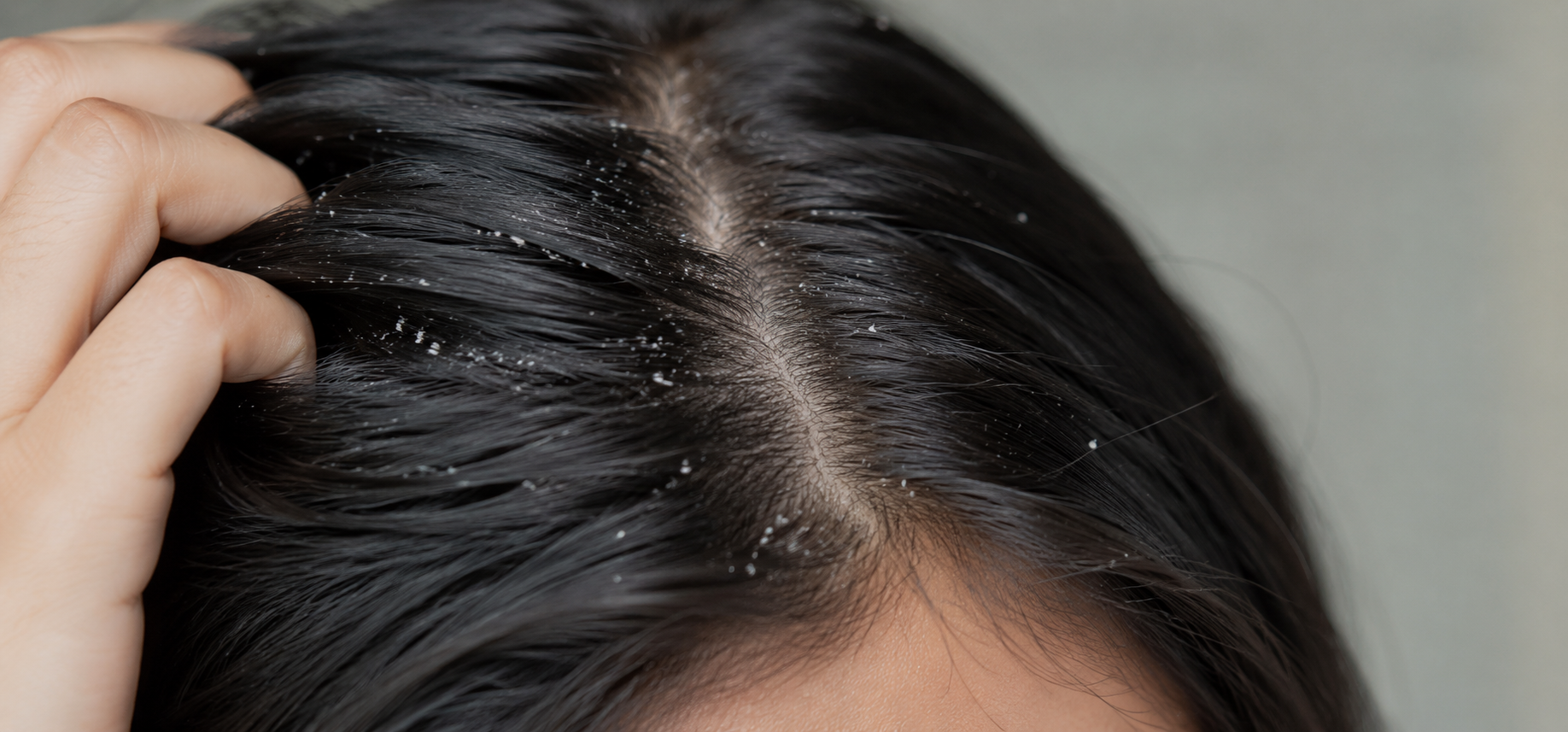 dandruff.png