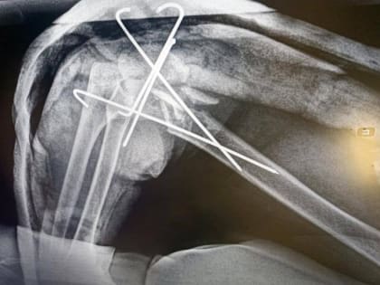 Четыре операции сразу потребовались попавшей под машину в Подмосковье пенсионерке