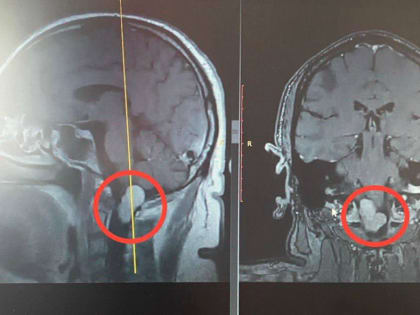 Врачи в Раменском удалили у пациента опухоль мозга размером с грецкий орех