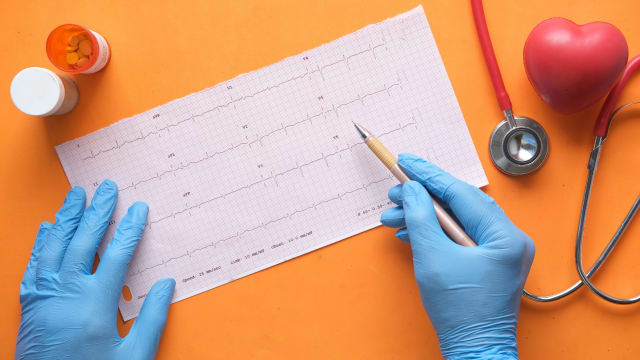Wolff-Parkinson-White (WPW) Syndrome: Causes, ECG Features, Symptoms, Diagnosis, and Treatment.