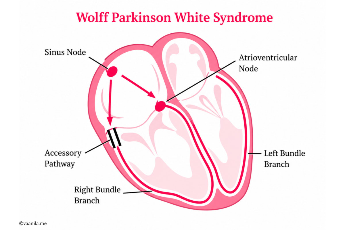 Diagram of Wolff-Parkinson-White syndrome.