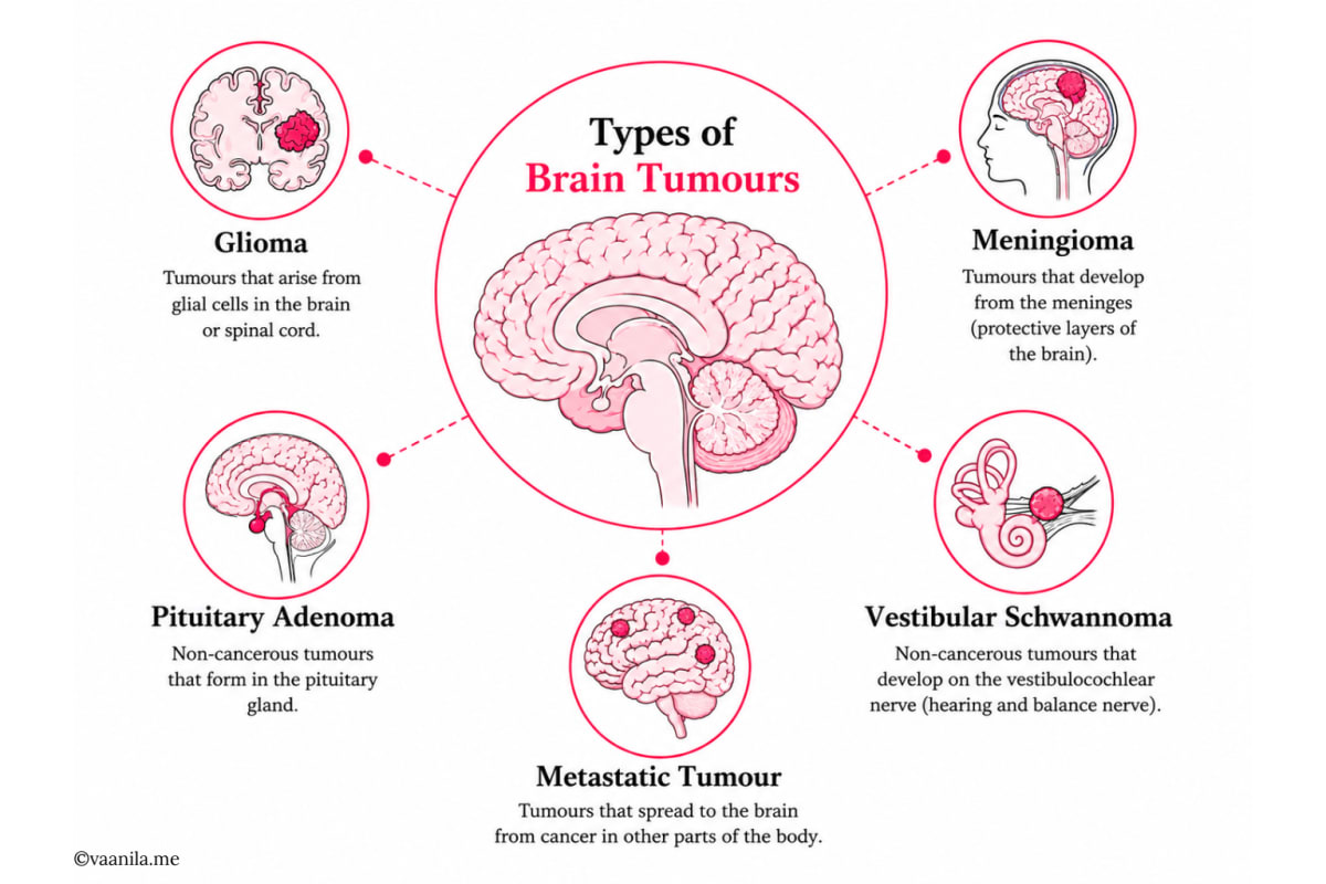 Types of Brain Tumours
