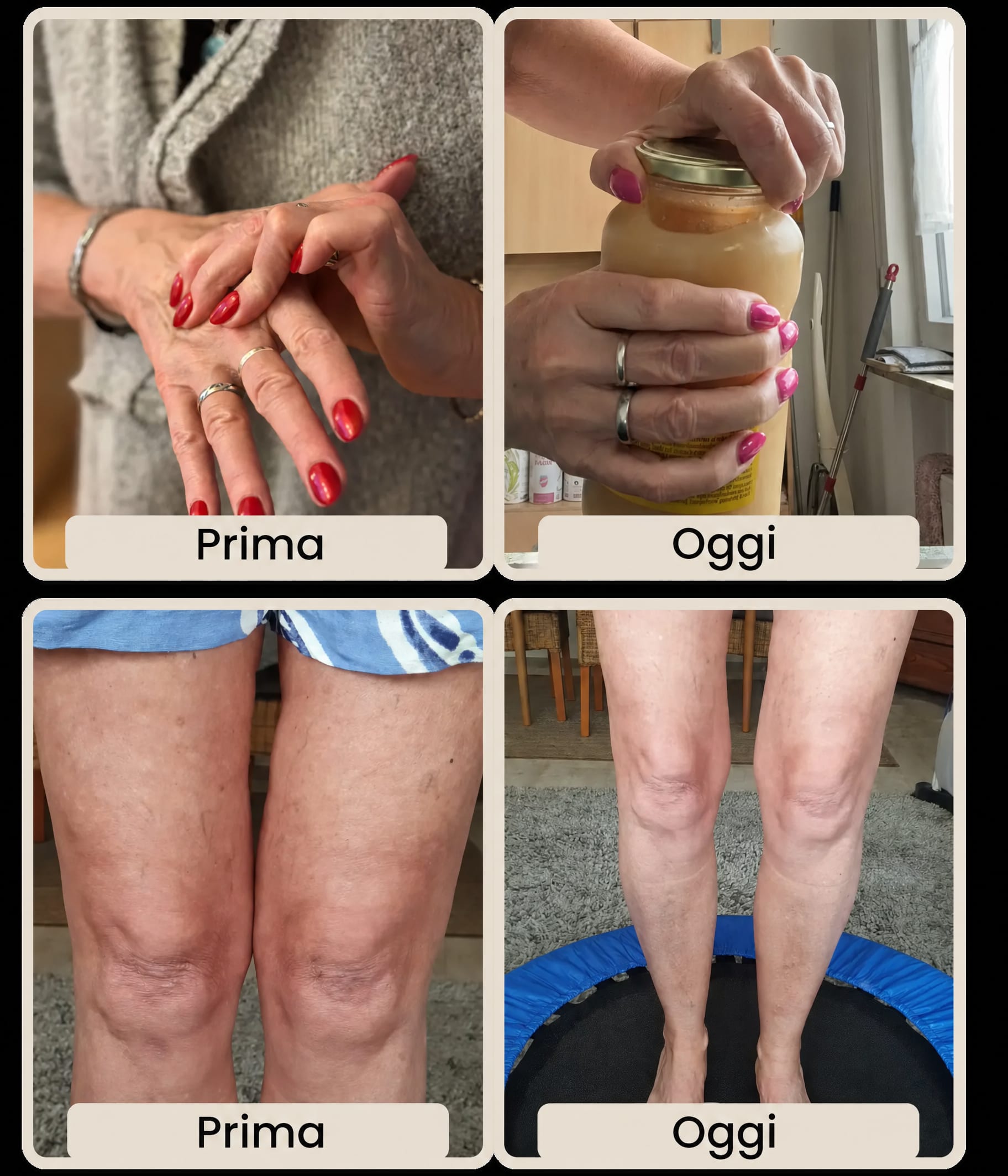 Prima/Dopo Giuliana (62 anni) — mani e ginocchia dopo 3 mesi di Glow25