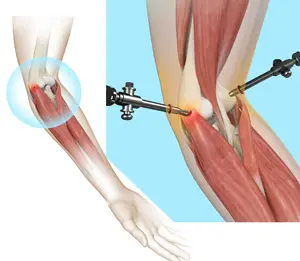 Elbow Pain