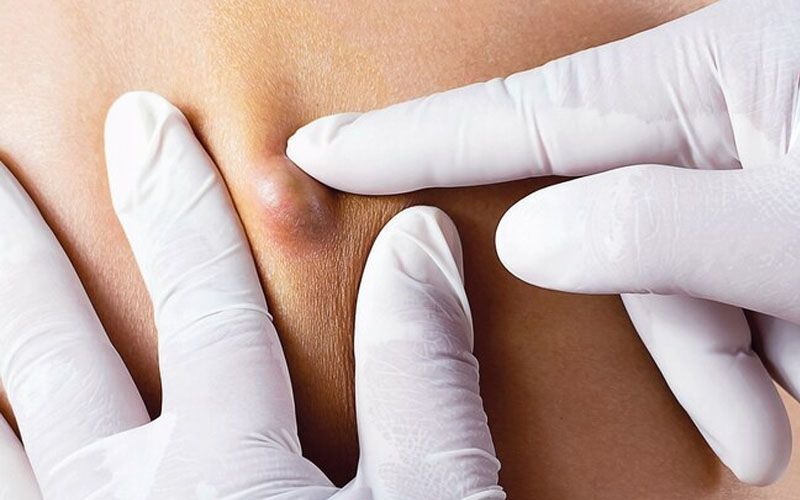 Kenali Penyakit Kista, Penyebab hingga Jenisnya