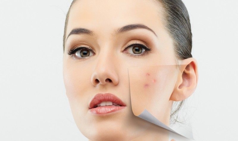 Muncul Jerawat Padahal Hanya di Rumah Saja? Ini Penjelasannya!