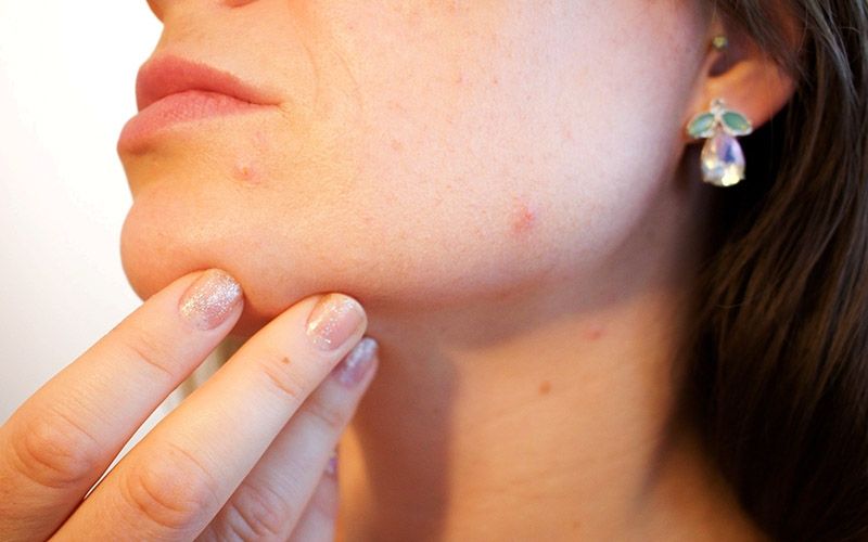 Sering Salah Kaprah, Apa Sih Bedanya Rosacea dengan Jerawat?