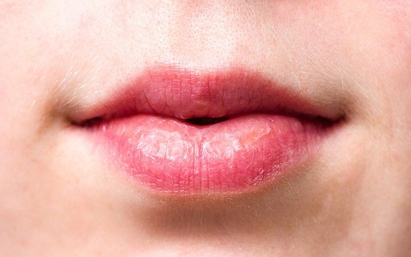 4 Penyebab Bibir Kering dan Pecah-pecah yang Jarang Diketahui
