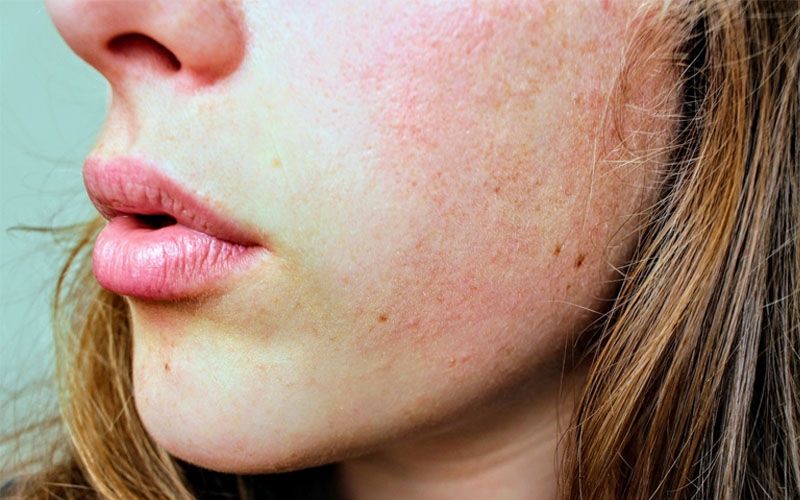 Kulit Wajah Mengelupas? Yuk Lakukan 5 Cara Ini Segera