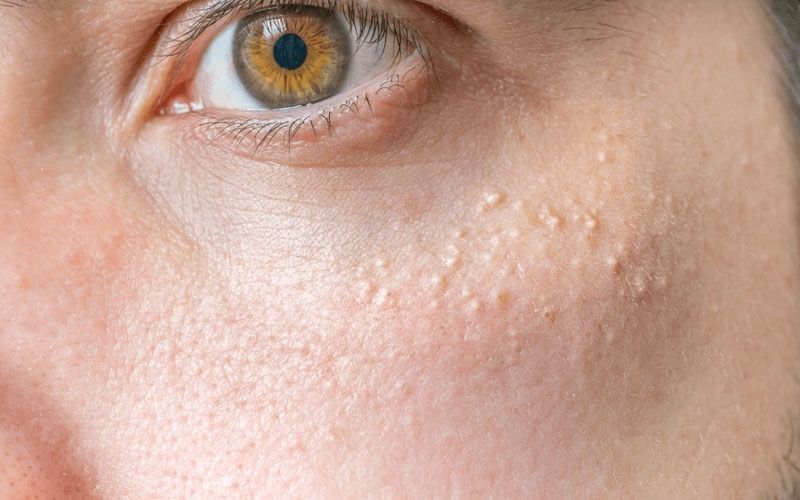 Sering Salah Kaprah! Ini Bedanya Milia, Beruntusan dan Fungal Acne